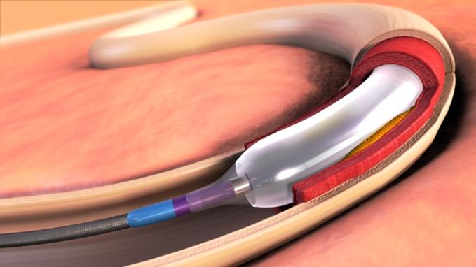 Интервенционная радиология